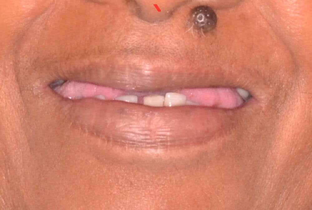Dr. Adatrow's Patient Before Implant-supported Dentures