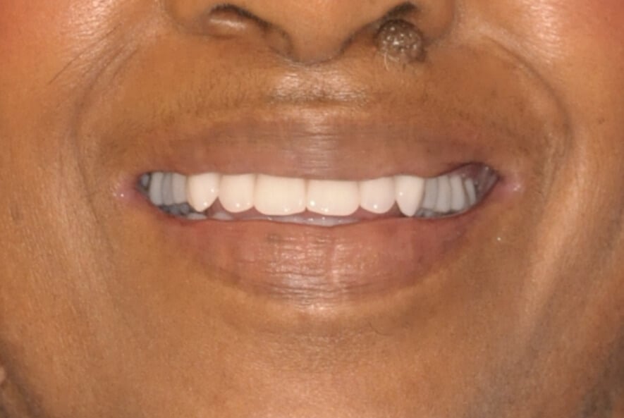 Dr. Adatrow's Patient After Implant-supported Dentures