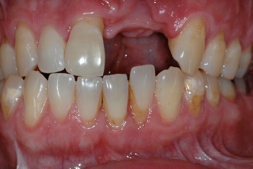 Dr. Adatrow's Patient Before Missing Tooth Replacement using Implant Bridge