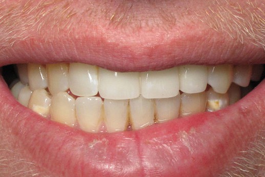 Dr. Adatrow's Patient After Missing Tooth Replacement using Implant Bridge