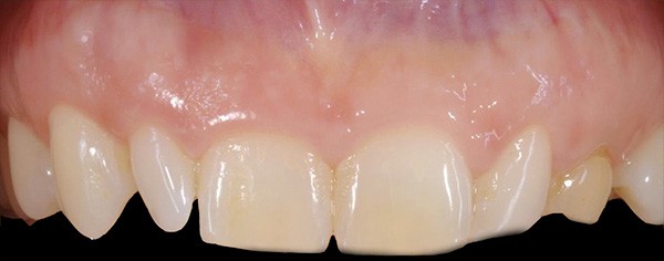 Dr. Adatrow's Patient Before Cosmetic Gum Recontouring with Veneers