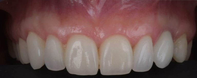 Dr. Adatrow's Patient After Cosmetic Gum Recontouring with Veneers