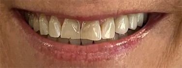 Dr. Adatrow's Patient 2 Before Smile Reconstruction with Dental Veneers