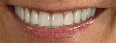 Dr. Adatrow's Patient 2 After Smile Reconstruction with Dental Veneers