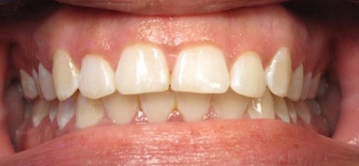 Dr. Adatrow's Patient 2 Before Esthetic Crown Lengthening