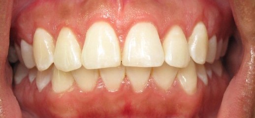 Dr. Adatrow's Patient 2 After Esthetic Crown Lengthening