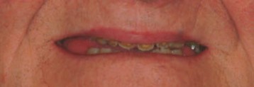 Dr. Adatrow's Patient Before All-on-X Dental Implants