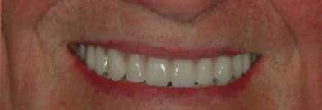 Dr. Adatrow's Patient After All-on-X Dental Implants