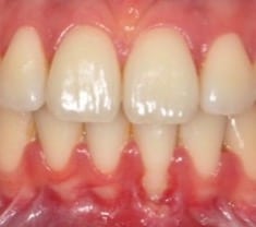 Dr. Adatrow's Patient 2 Before Gum Recession Corrected By Grafting