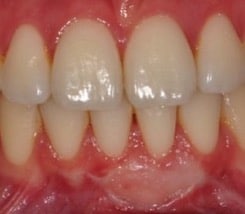 Dr. Adatrow's Patient 2 After Gum Recession Corrected By Grafting