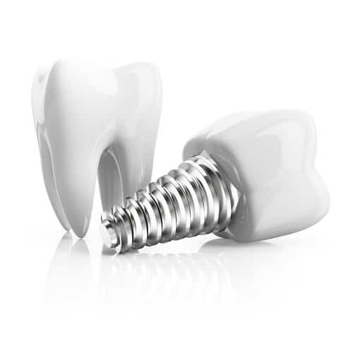 The 2 Types of Dental Implants