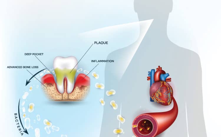  Are periodontal disease and heart disease-related?