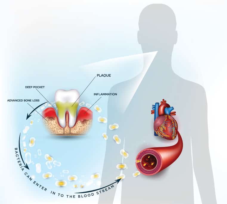  A Dual Threat: Navigating the Risks of Periodontal & Heart Diseases Together