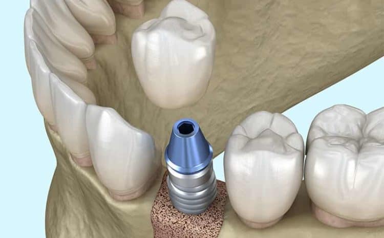  3 Types of Best Bone Grafting Procedures for Dental Implants