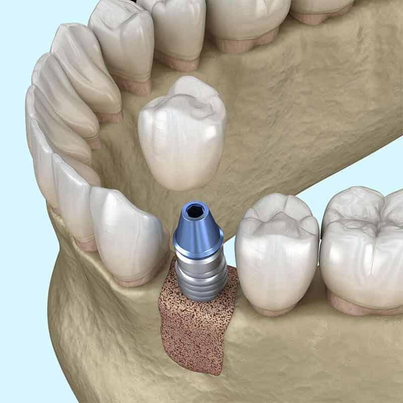  3 Types of Best Bone Grafting Procedures for Dental Implants
