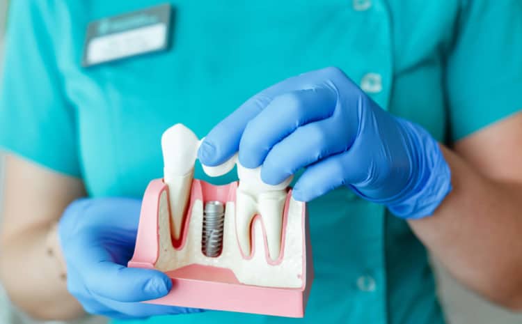  Is Second Opinion Crucial for Dental Implants Surgery?