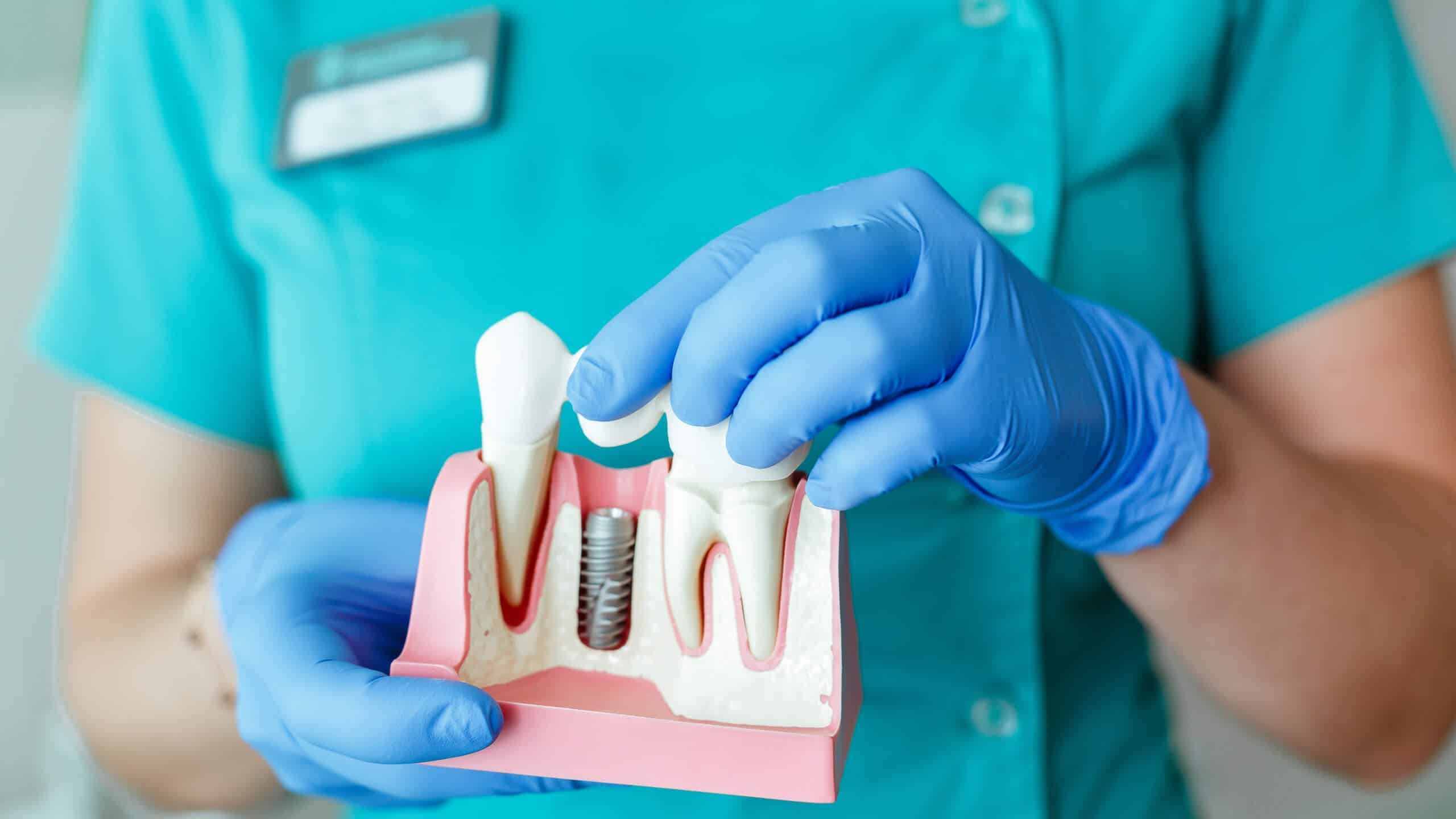  Is Second Opinion Crucial for Dental Implants Surgery?