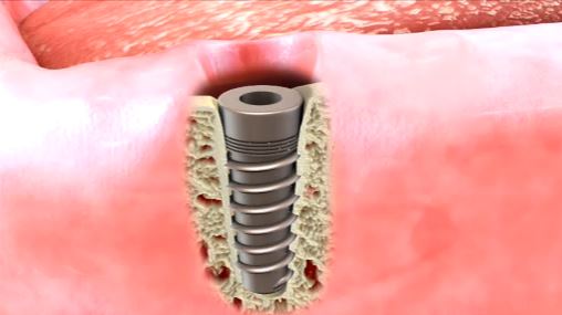  Osseointegration Of Dental Implants