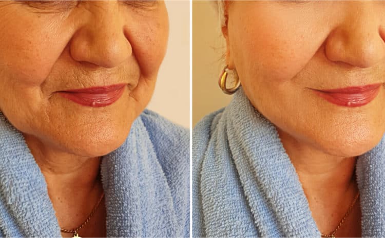 Best Saggy Face Skin Treatment With Dental Implants To Look Younger