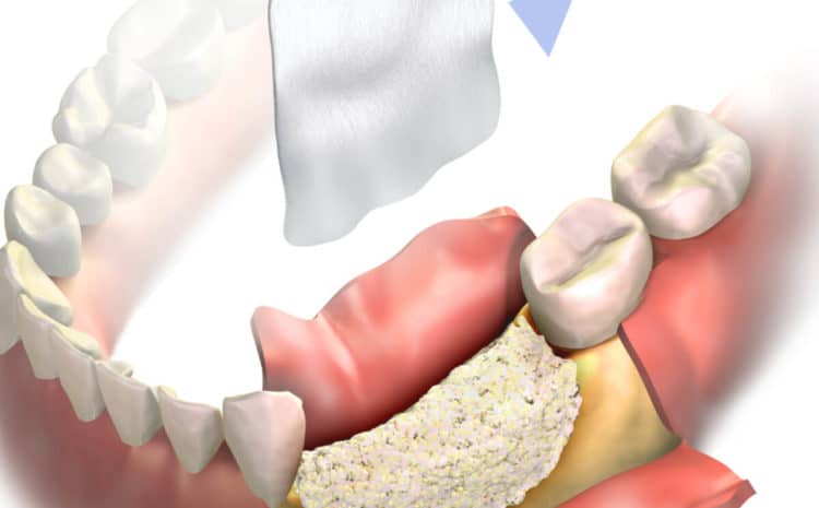  Will I Need Bone Graft Before Great Dental Implant Procedure