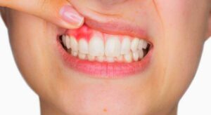 Best gum disease treatment in Memphis, TN