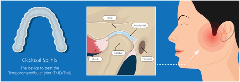 Occlusal Splints to Treat TMJ dysfunction