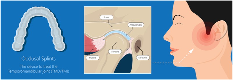 Occlusal Splints to Treat TMJ dysfunction