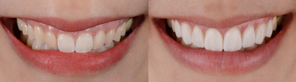 Dr. Adatrow's Patient Before and After Porcelain Veneers, Mississippi