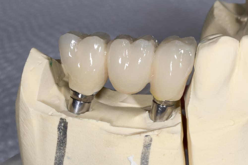  2 Types of Dental Implant Crowns – Why You should Know about Them?