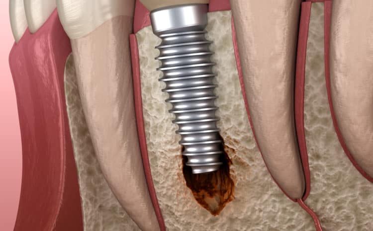  All You Need to Know About Peri Implantitis