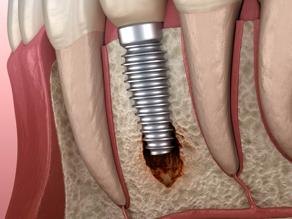  All You Need to Know About Peri Implantitis