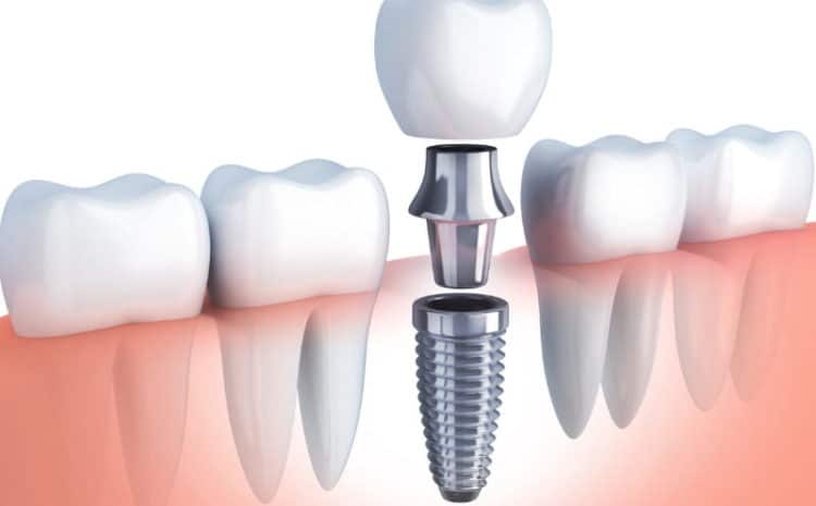  Are Immediate Load Dental Implants Beneficial for You?