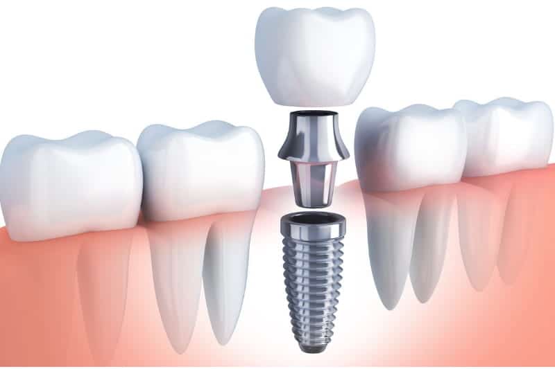  Are Immediate Load Dental Implants Beneficial for You?