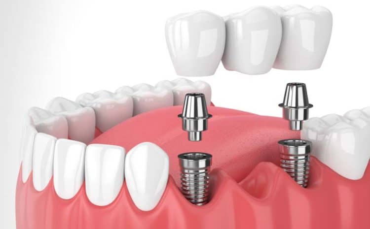  6 Signs for The Best Dental Implant Specialist