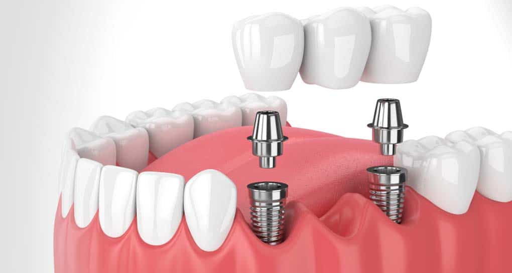 6 Signs for The Best Dental Implant Specialist