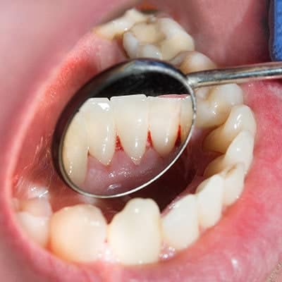 Bleeding Gums Disease