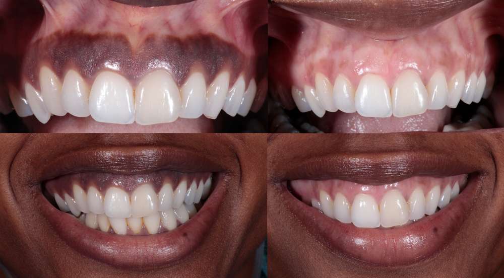 Dark Gums Treatment