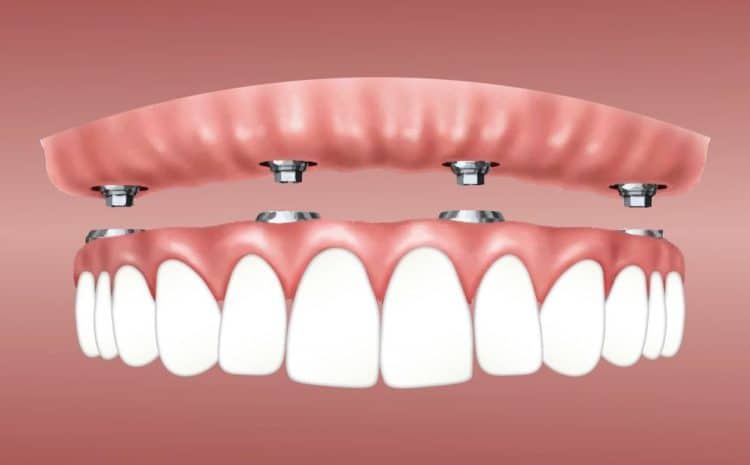  Demystifying 2 Best Types of Snap-in Dentures