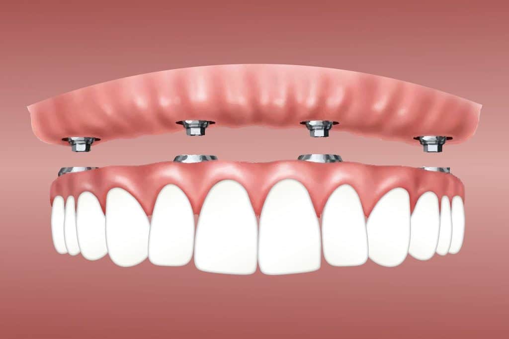  Demystifying 2 Best Types of Snap-in Dentures