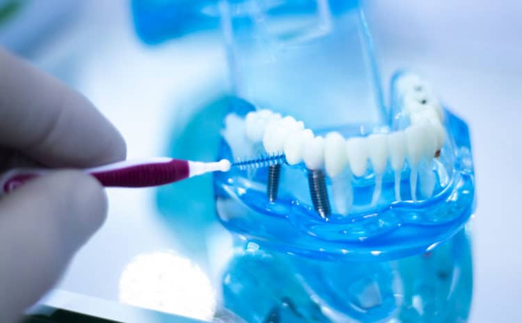  Dental Implant Care – Before, After, and Beyond