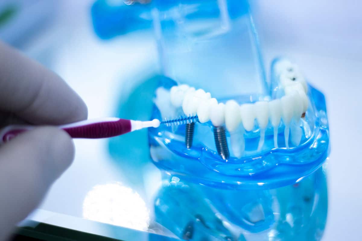  Dental Implant Care – Before, After, and Beyond
