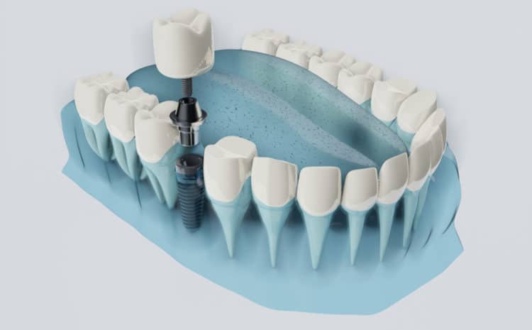  Digital Dental Implant Surgery – What is it?