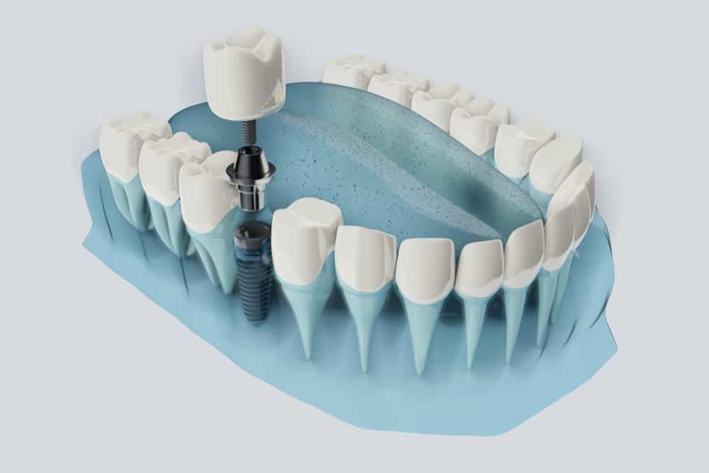  Digital Dental Implant Surgery – What is it?