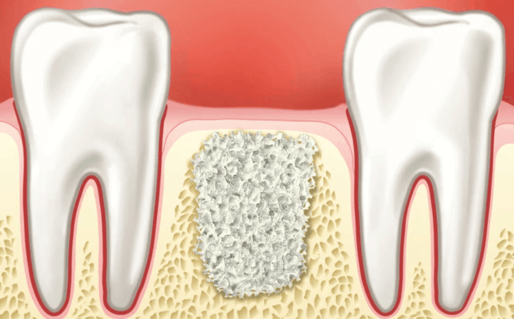  Alveolar Socket Preservation: A Must-Know for Effective Tooth Replacement Strategies