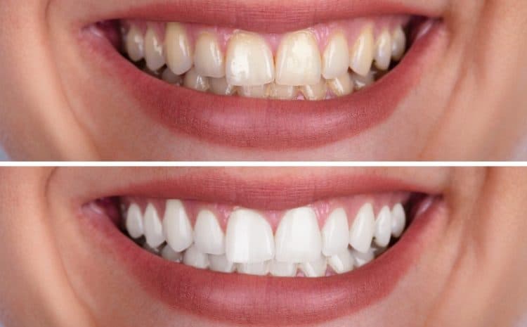  Can Full Mouth Reconstruction Help in Your Smile Restoration?
