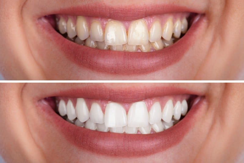  Can Full Mouth Reconstruction Help in Your Smile Restoration?