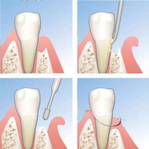 Osseous Surgery Procedure by Dr. Adatrow