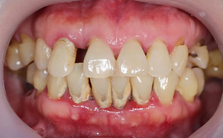  Periodontal Disease and Dental Implants  – What is the Relation?