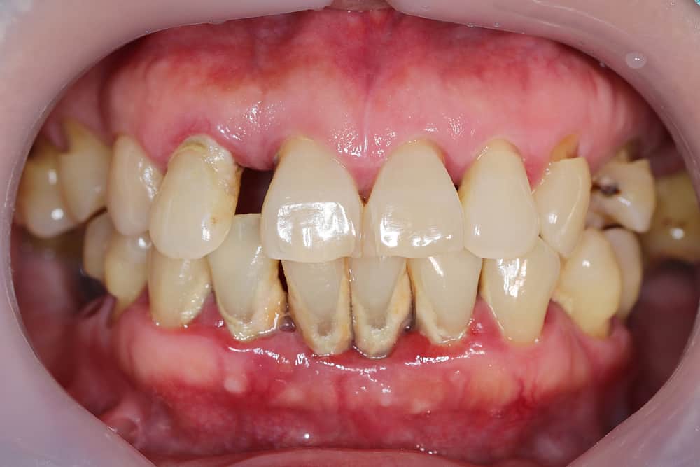  Periodontal Disease and Dental Implants  – What is the Relation?