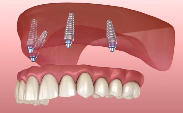  How are Snap-in dentures different from other dentures?